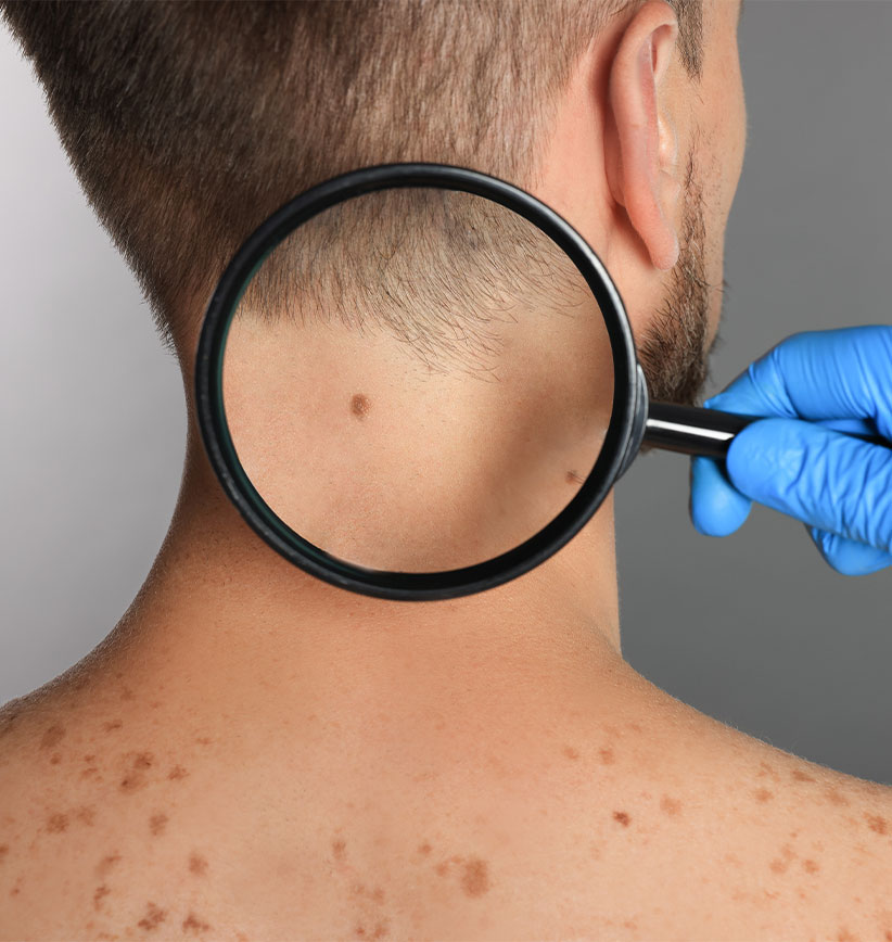 Skin Cancer Clinic Prestons NSW