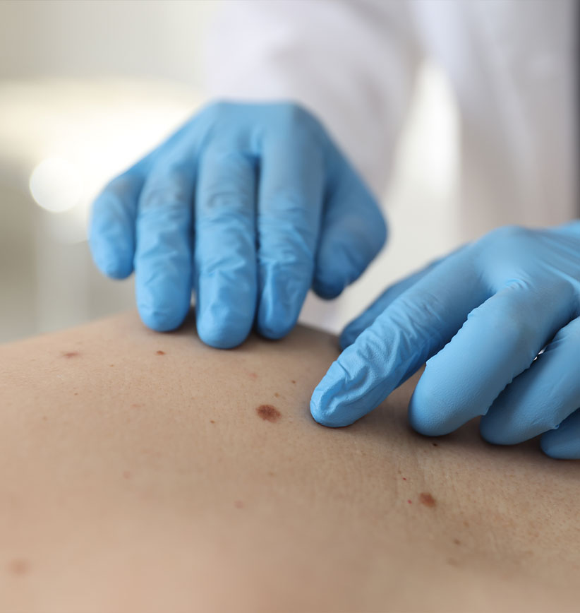 melanoma treatment Prestons