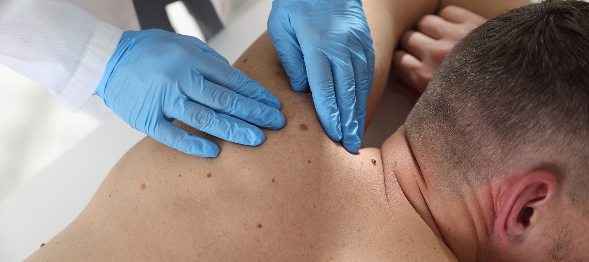 Skin cancer check at Sun Smile Clinic, a skin cancer clinic near Liverpool NSW