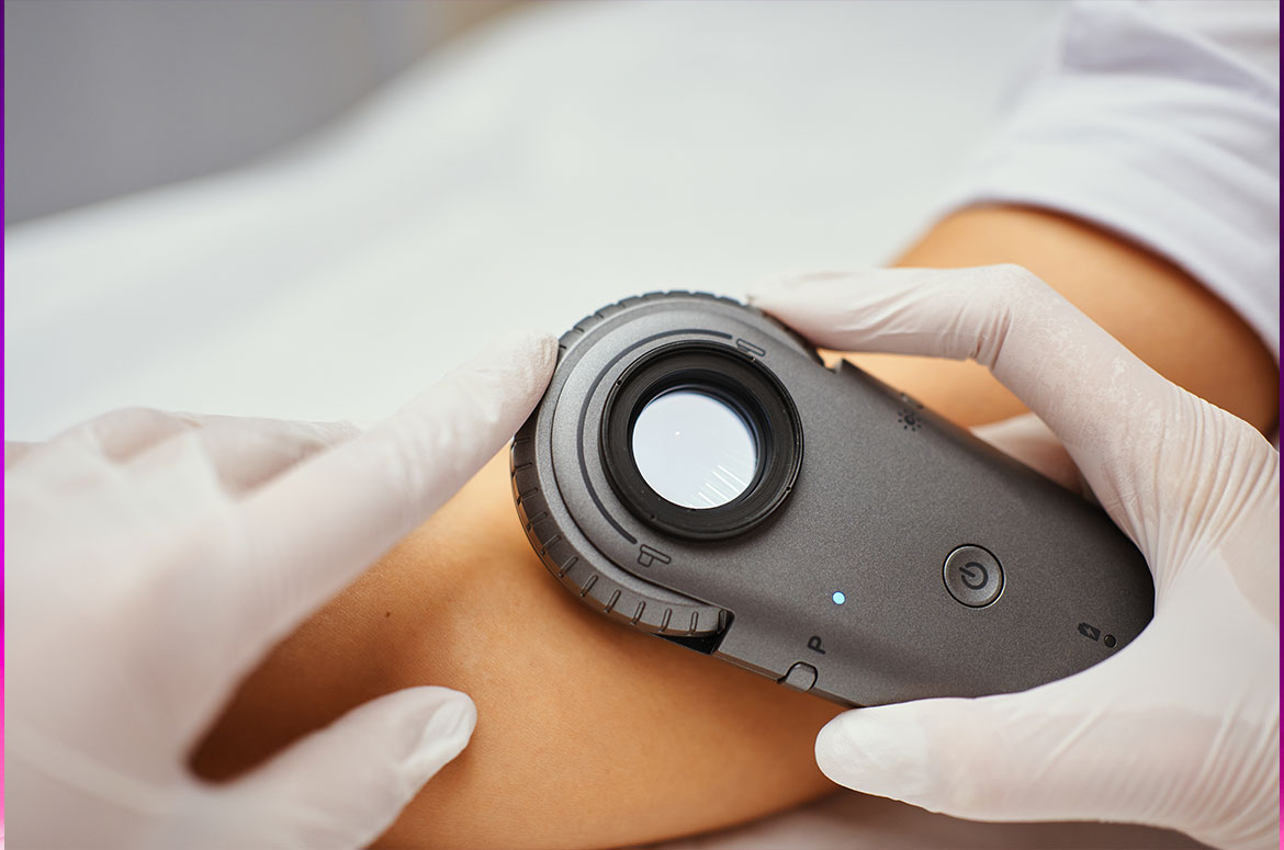 Dermoscopy skin examination at Sun Smile Clinic, a skin cancer clinic near Minto NSW